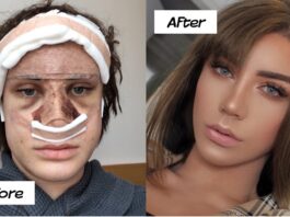 The Recovery Process - What to Expect After Plastic Surgery